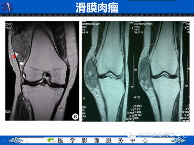 【病例学习】软组织内恶性孤立性纤维肉瘤一例