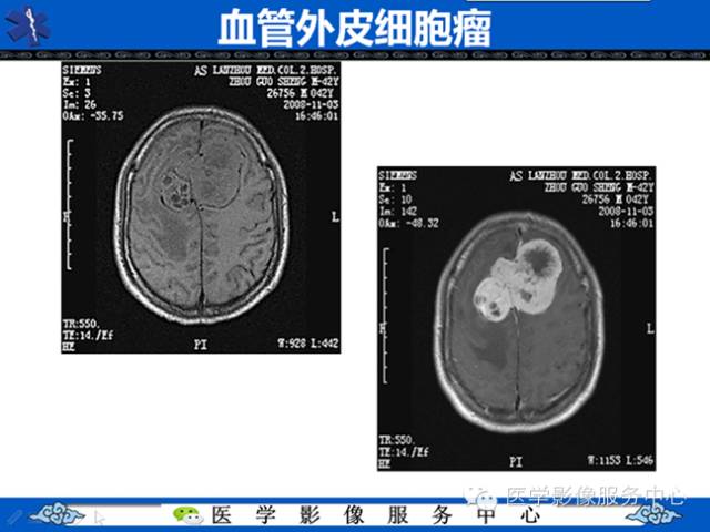 【病例学习】软组织内恶性孤立性纤维肉瘤一例