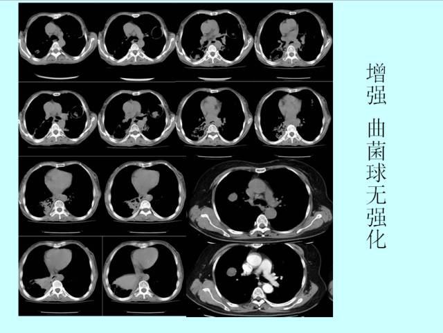 肺曲霉菌病分型与影像诊断