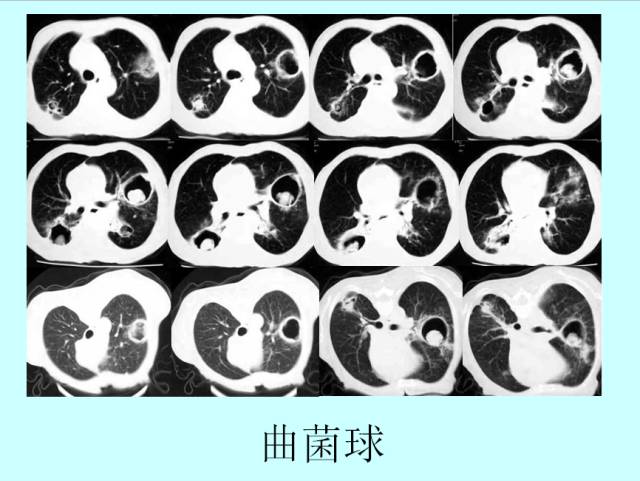 肺曲霉菌病分型与影像诊断
