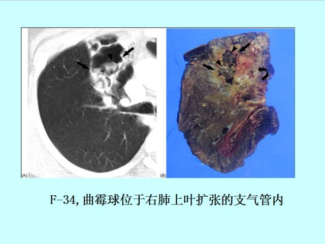 肺曲霉菌病分型与影像诊断