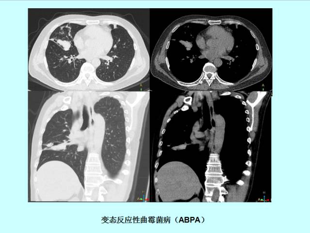 肺曲霉菌病分型与影像诊断
