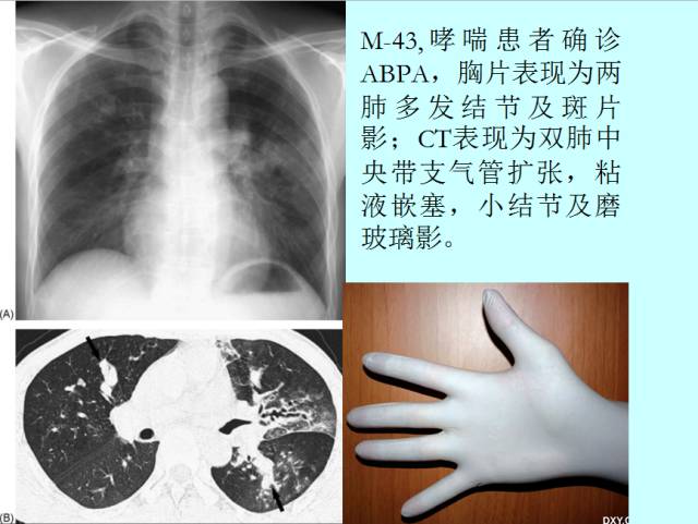 肺曲霉菌病分型与影像诊断