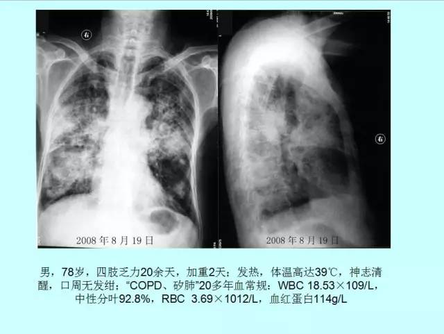 肺曲霉菌病分型与影像诊断