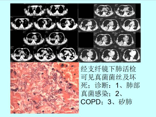 肺曲霉菌病分型与影像诊断