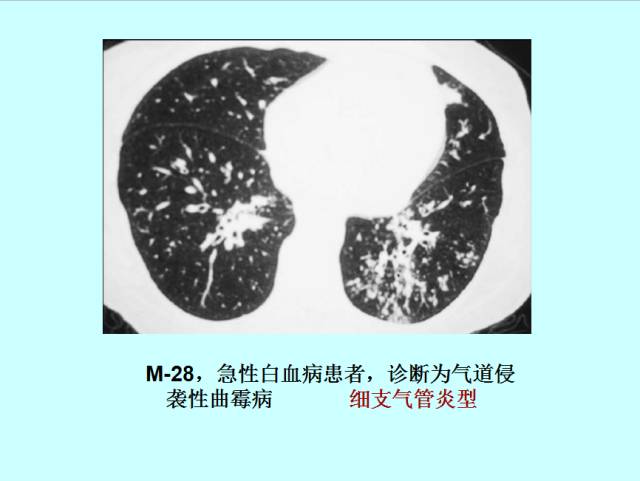 肺曲霉菌病分型与影像诊断