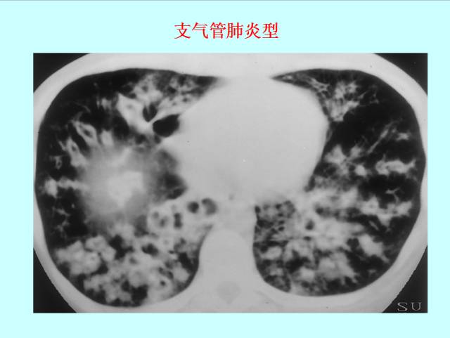 肺曲霉菌病分型与影像诊断