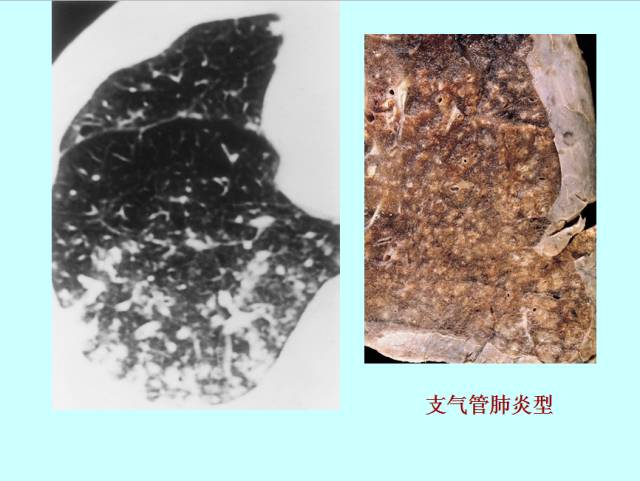 肺曲霉菌病分型与影像诊断