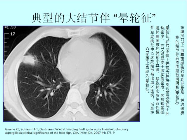 肺曲霉菌病分型与影像诊断