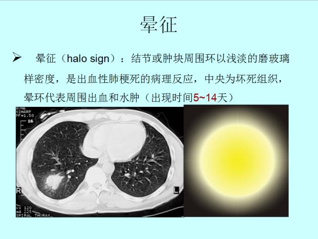 肺曲霉菌病分型与影像诊断