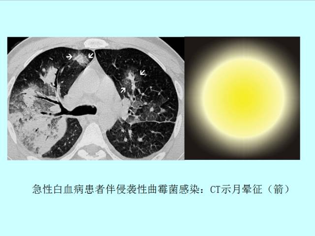 肺曲霉菌病分型与影像诊断