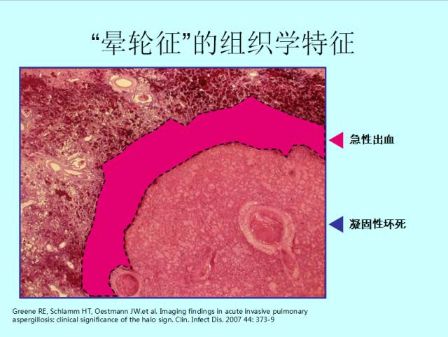 肺曲霉菌病分型与影像诊断