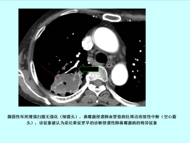 肺曲霉菌病分型与影像诊断