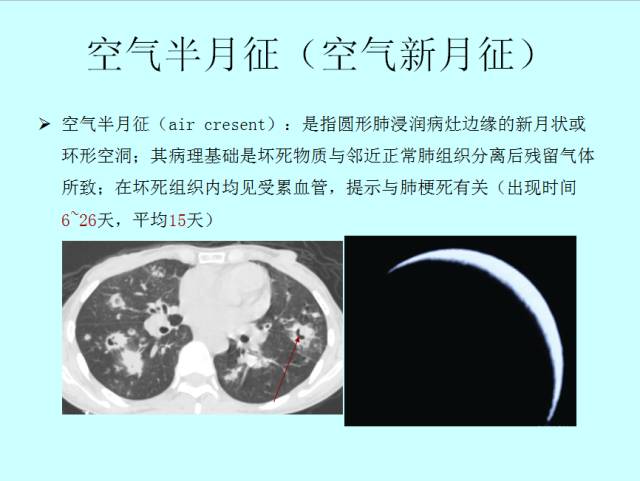 肺曲霉菌病分型与影像诊断