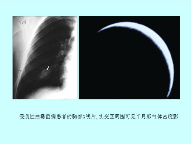 肺曲霉菌病分型与影像诊断