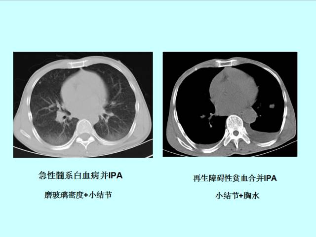 肺曲霉菌病分型与影像诊断