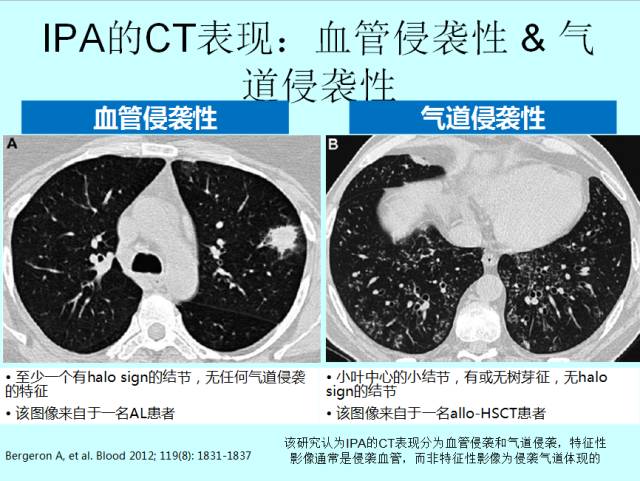 肺曲霉菌病分型与影像诊断