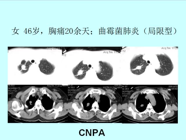 肺曲霉菌病分型与影像诊断