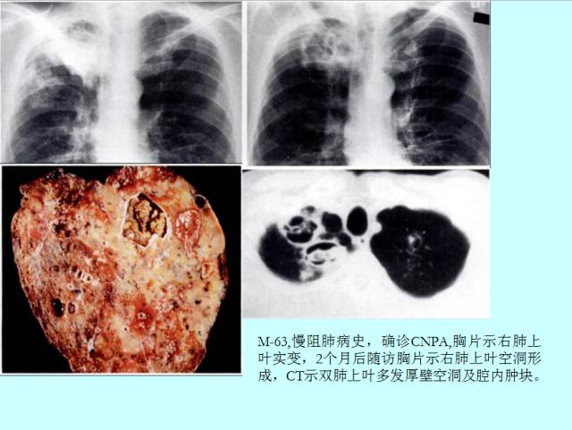 肺曲霉菌病分型与影像诊断