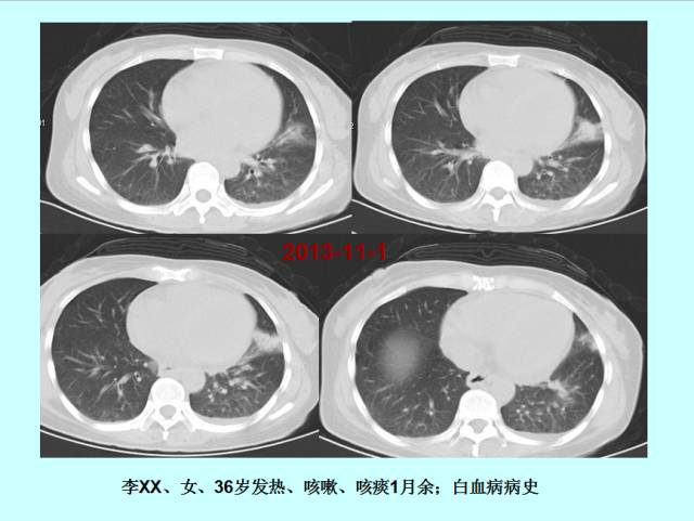 肺曲霉菌病分型与影像诊断
