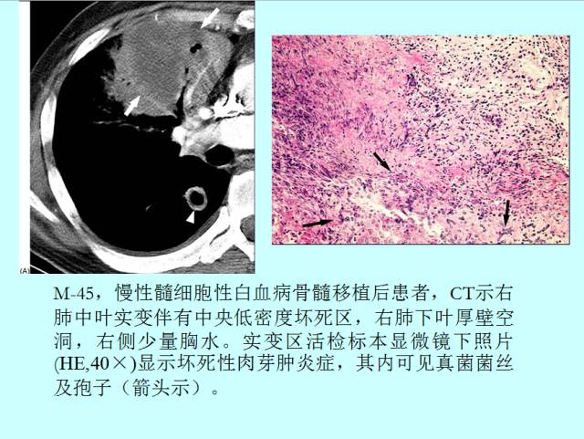 肺曲霉菌病分型与影像诊断