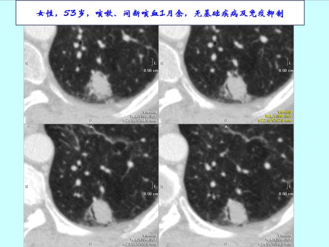 肺曲霉菌病分型与影像诊断