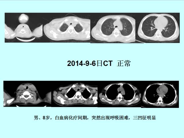 肺曲霉菌病分型与影像诊断