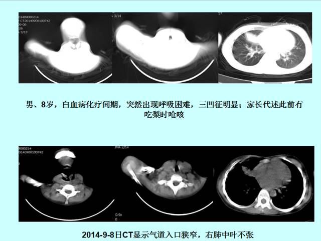 肺曲霉菌病分型与影像诊断