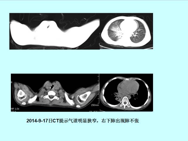 肺曲霉菌病分型与影像诊断