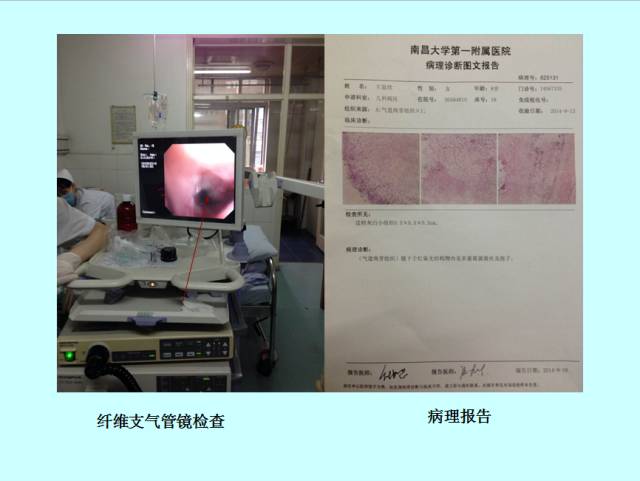 肺曲霉菌病分型与影像诊断