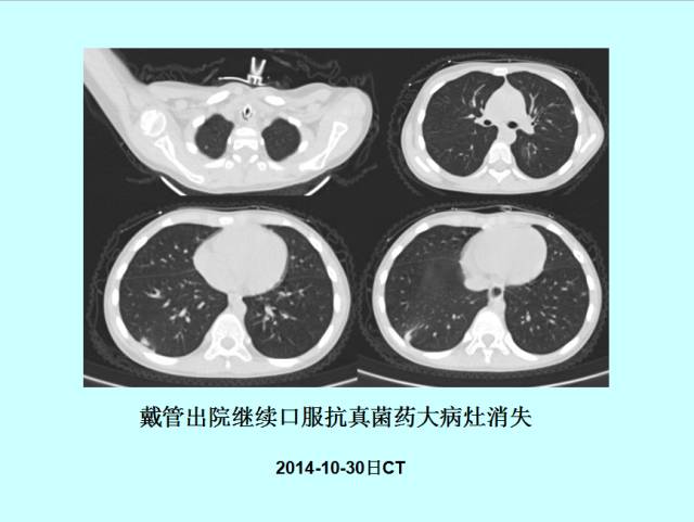 肺曲霉菌病分型与影像诊断