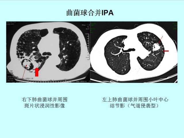 肺曲霉菌病分型与影像诊断