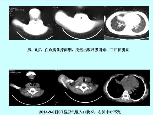 肺曲霉菌病分型与影像诊断
