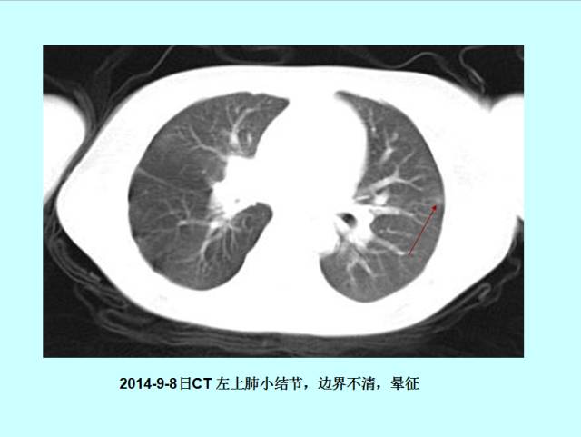 肺曲霉菌病分型与影像诊断