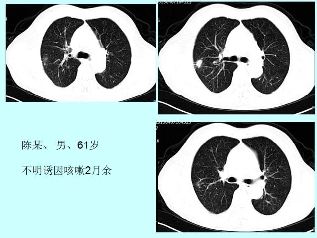 肺曲霉菌病分型与影像诊断