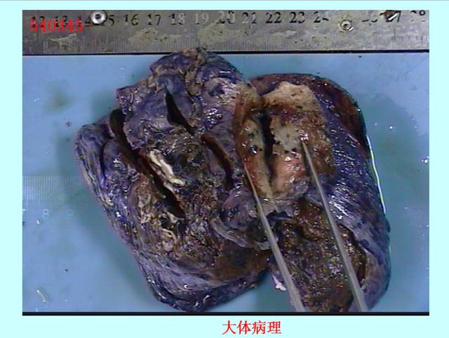 肺曲霉菌病分型与影像诊断