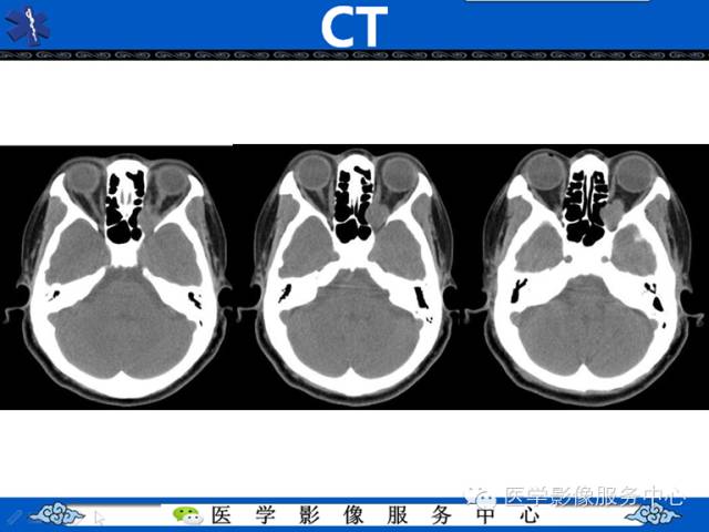 【病例学习】左眼眶腺样囊腺癌一例影像表现