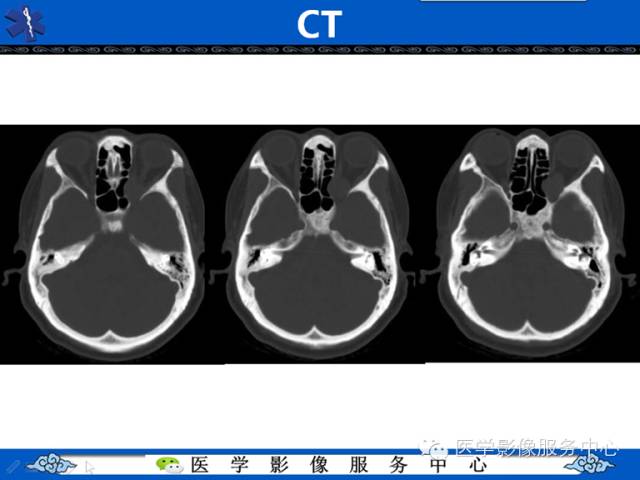 【病例学习】左眼眶腺样囊腺癌一例影像表现