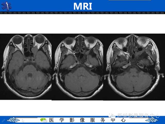 【病例学习】左眼眶腺样囊腺癌一例影像表现