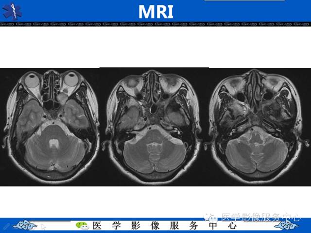 【病例学习】左眼眶腺样囊腺癌一例影像表现