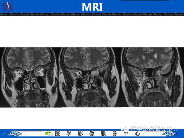 【病例学习】左眼眶腺样囊腺癌一例影像表现