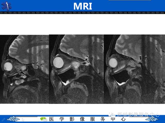 【病例学习】左眼眶腺样囊腺癌一例影像表现