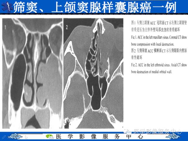【病例学习】左眼眶腺样囊腺癌一例影像表现