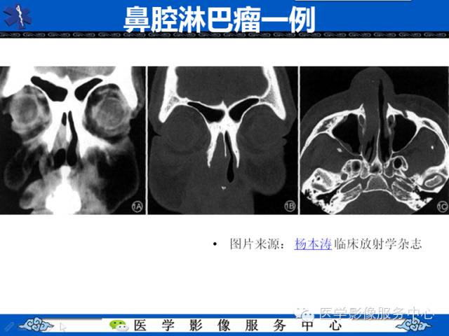 【病例学习】左眼眶腺样囊腺癌一例影像表现
