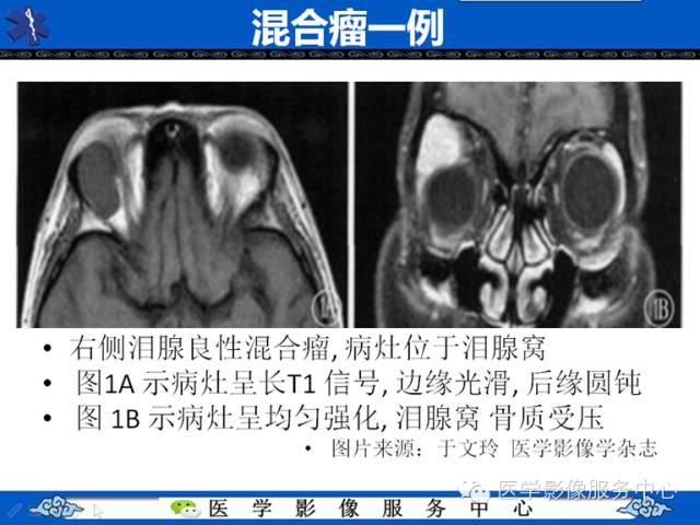 【病例学习】左眼眶腺样囊腺癌一例影像表现