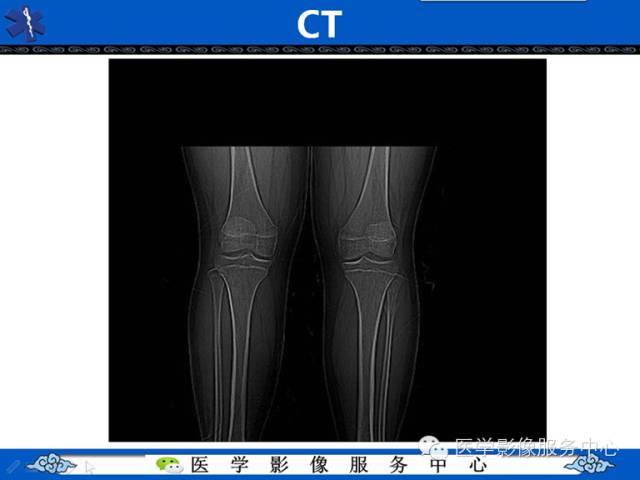 【病例学习】腓骨骨肉瘤一例影像诊断与鉴别