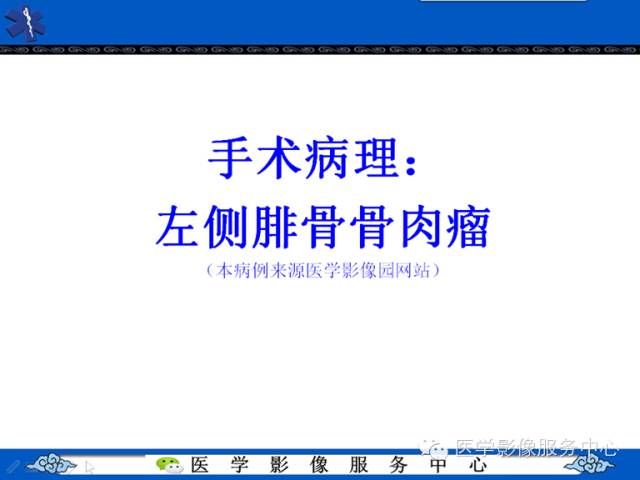 【病例学习】腓骨骨肉瘤一例影像诊断与鉴别