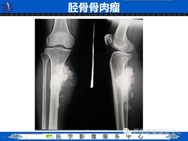【病例学习】腓骨骨肉瘤一例影像诊断与鉴别