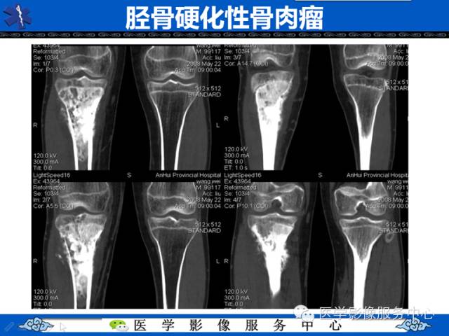 【病例学习】腓骨骨肉瘤一例影像诊断与鉴别