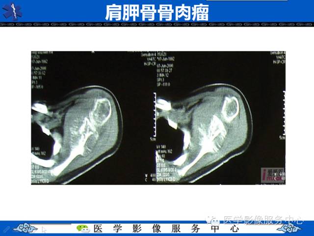 【病例学习】腓骨骨肉瘤一例影像诊断与鉴别